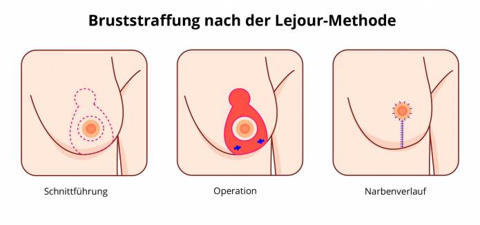 Lejour-Methode der Bruststraffung