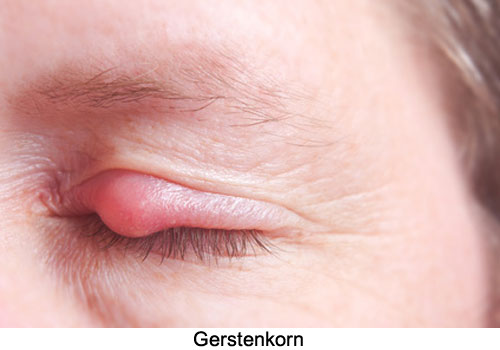 Gerstenkorn