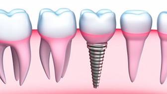 Implantate - Alternative zu herkömmlichem Zahnersatz
