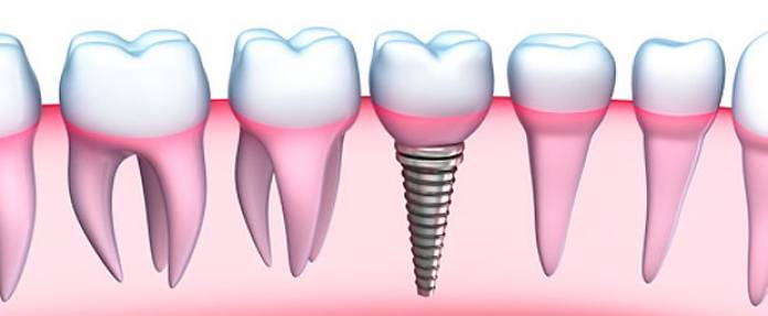 Implantate als Alternative zu Zahnprothesen