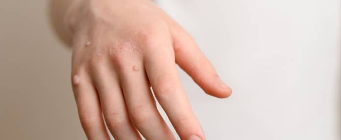 Warzen an der Hand