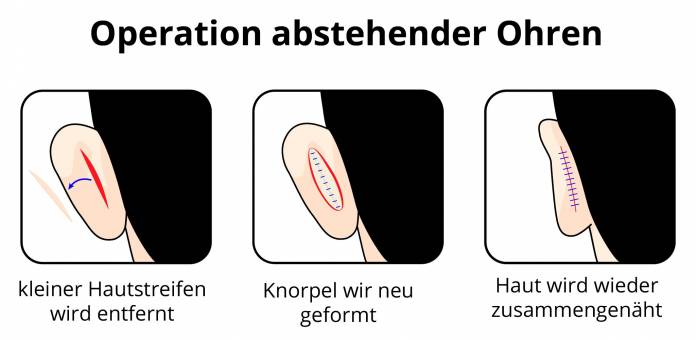 Ablauf Operation Segelohren