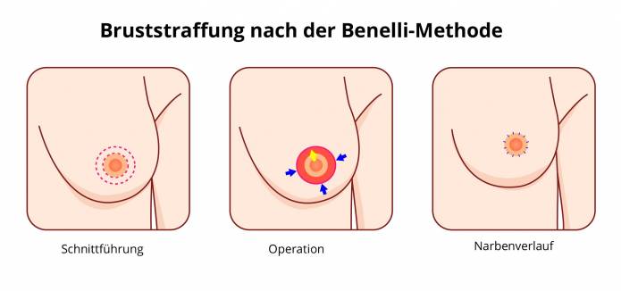 Benelli-Methode