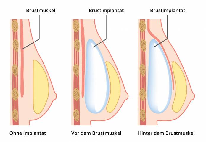 Brustvergrößerung mit Implantat