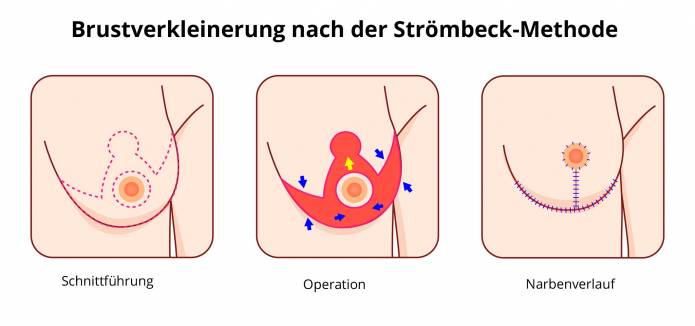 Brustverkleinerung nach Strömbeck