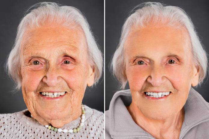 Facelift - vorher-nachher-Foto