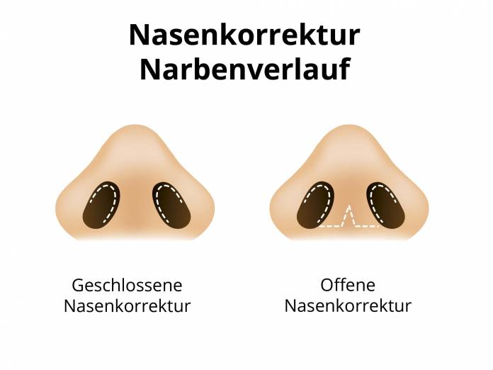 Offene / Geschlossene Rhinoplastik