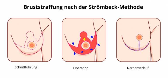 Bruststraffung Strömbeck-Methode